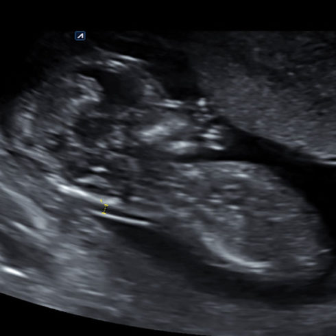 Alpinion Italia | ECube-15 | Fetus at 12 weeks in 2D