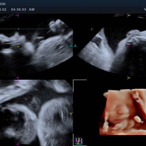 Alpinion Italia | Fetal face in 3D MPR mode with live HQ