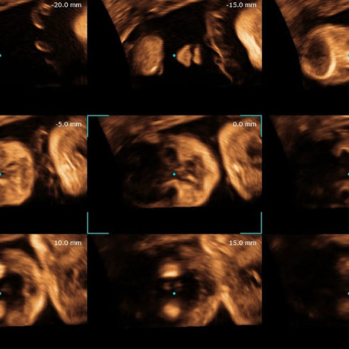 Alpinion Italia | Fetal face in multi slice view of volume master