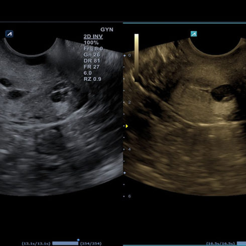 Alpinion Italia | Uterine cervix in dual mode