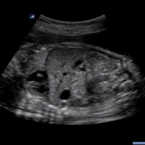 Alpinion Italia | Fetal abdomen