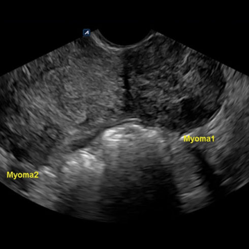 Alpinion Italia | Myoma in the uterus