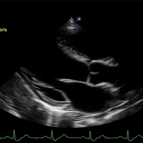 Alpinion Italia | Pediatric echocardiography with SP3-8T transducer